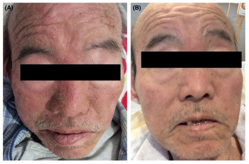 44歳男性 四肢先端の角化病変 : 今日なに読もう〜病院総合診療医