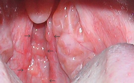 インフルエンザA(咽頭所見:イクラ様) : こどもの病気・おとなの病気