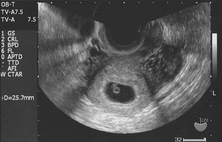 6週4日 心拍確認 クマさんと猫ムスメ