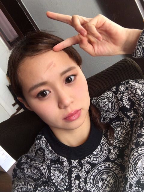 Juice Juice 高木紗友希がヘアアイロンでおでこに火傷をした件 ハロプロまとめたった