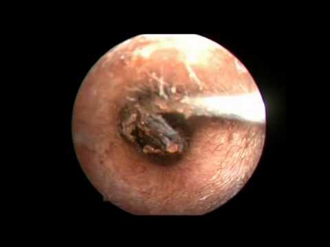 二年間耳掃除しなかったら大変な事になった 暇人まとめニュース速報