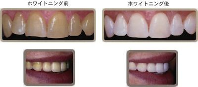 歯を白くする方法を全て教えてやる 美容ニュースまとめ