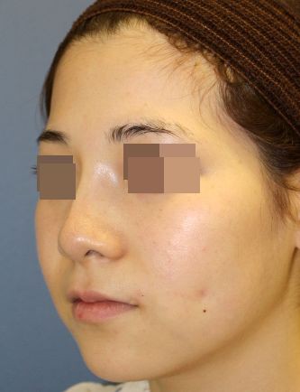 B えくぼ形成術手術後1か月の経過写真 プリモ麻布十番クリニック美容形成外科医のブログ