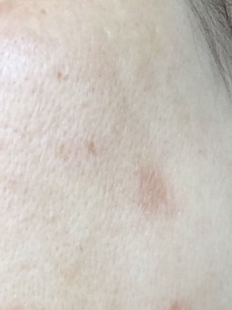 シミが薄くなるのって楽しい ハイドロキノン トレチノインでシミを消す