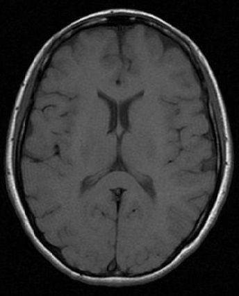 脳画像 MRIの見方 : 看護.com