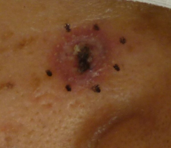 基底細胞癌（上皮腫）切除＋皮弁術。。。。 : おちあい皮膚科クリニック