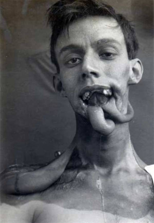 グロ 第一次世界大戦の頃に行われていた整形手術の写真がこちら おちんぽみるく速報