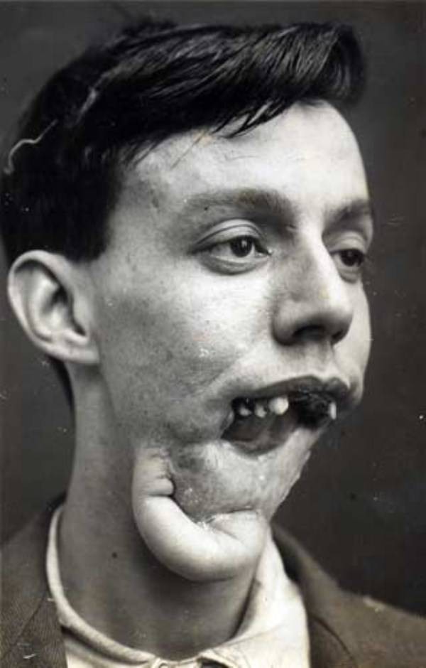 グロ 第一次世界大戦の頃に行われていた整形手術の写真がこちら おちんぽみるく速報