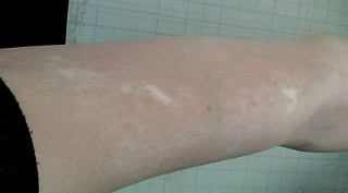 尋常性白斑が殆ど目立たなくなり消えた部分もある写真です 木室ミヱ子の漢方薬 尋常性白斑が殆ど目立たなくなり消えた部分もある写真です 木室ミヱ子の漢方薬