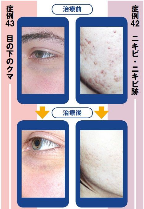 毛穴の開きや黒ずみも医療レーザーで治すことができる 精美スキンケアクリニック ブリッジ セラピーによる ニキビ ニキビ跡 毛穴の開き 目の下のクマ 完全治療マニュアル