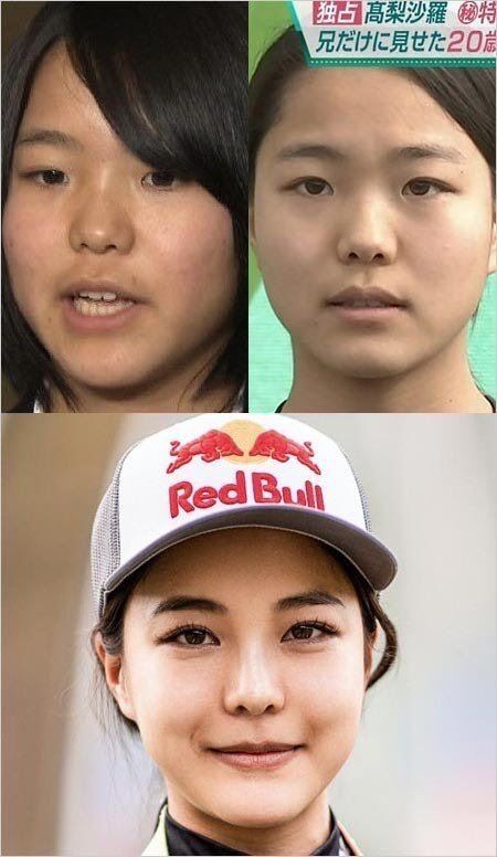 閲覧注意 整形モンスター高梨沙羅 ついに顔面ボロボロに アイドル整形 美容まとめ