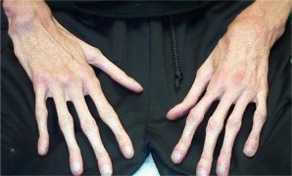 クモの様に指の長い 蜘蛛指症 の人々の手 ザイーガ クモの様に指の長い 蜘蛛指症 の人々の手 ザイーガ