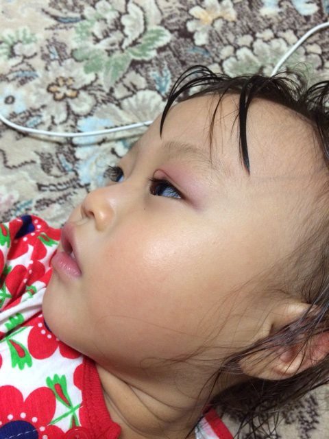 目の病気 娘の霰粒腫 Pastaya
