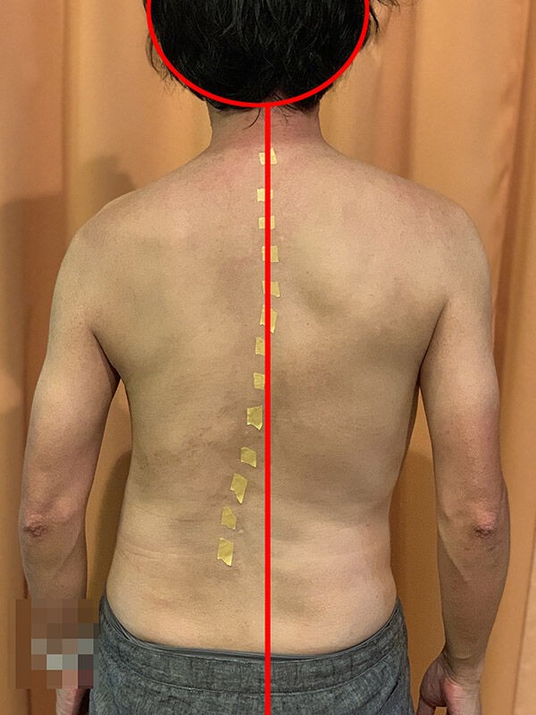 身体の傾き 50代の側弯症手術