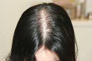 同じ分け目はハゲるのか しぶログ