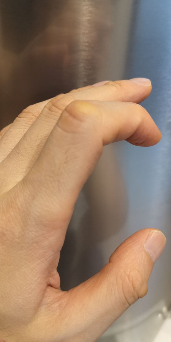 柑皮症で全身真っ黄色 カロテンは肌黄色くなります トイプーポッチャマ