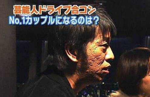 で 出た ｗニキビ潰しすぎて顔面クレーター奴ｗｗｗｗｗ ぶる速 Vip