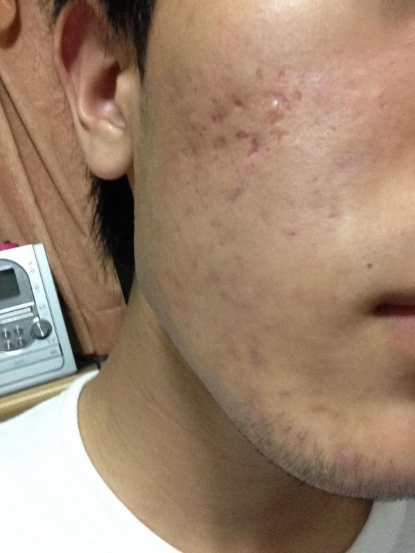 閲覧注意 ニキビ跡が酷すぎて笑えない ぶる速 Vip