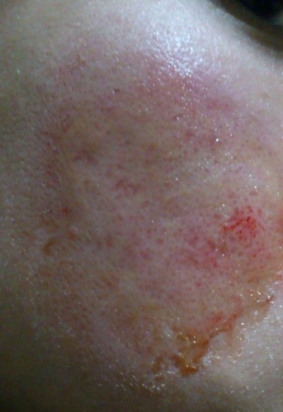 閲覧注意 ヤスリで肌を削ったらクレーターになったニキビ跡が薄くなった らいらい速報 Vip 閲覧注意 ヤスリで肌を削ったらクレーターになったニキビ跡が薄くなった らいらい速報 Vip