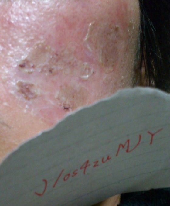 閲覧注意 ヤスリで肌を削ったらクレーターになったニキビ跡が薄くなった らいらい速報 Vip