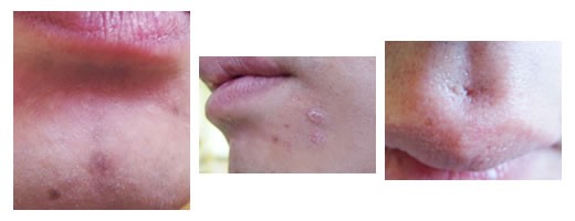 顔のニキビや染みやクレーターを目立たなくする コンシーラー の効果の程 鳥取の社長日記