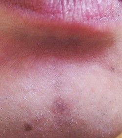 顔のニキビや染みやクレーターを目立たなくする コンシーラー の効果の程 鳥取の社長日記