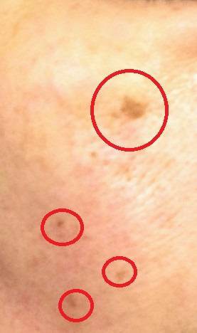 シミ画像あり 肌のシミクリーム Noko を三ヶ月試した結果を公開 Rinのシンプルライフ Powered By ライブドアブログ