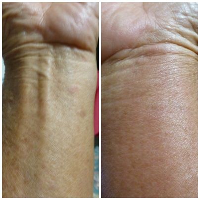 アブ被害 三角畑作業 Rive1565doorのblog