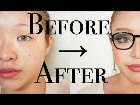 子供 そばかす 消す 方法