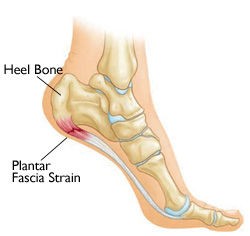 日本人が知らない足底筋膜炎の改善法６ステップ マラソン ランニングによる足裏の痛み Runart ランナート足の治療院ブログ