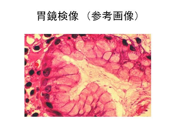 5 9 勉強会 33歳女性 心窩部痛と吐血 Ryu Sceo 琉球大学 医学部pbl勉強会