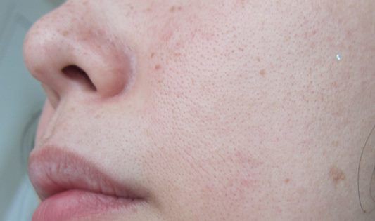 サエル しみへの効果は ４ヶ月使った感想 美白サエル 効果を実感中 新トライアルセット価格１４８０円送料無料