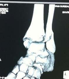 左足首を骨折しました 松浦茂樹 ブログ
