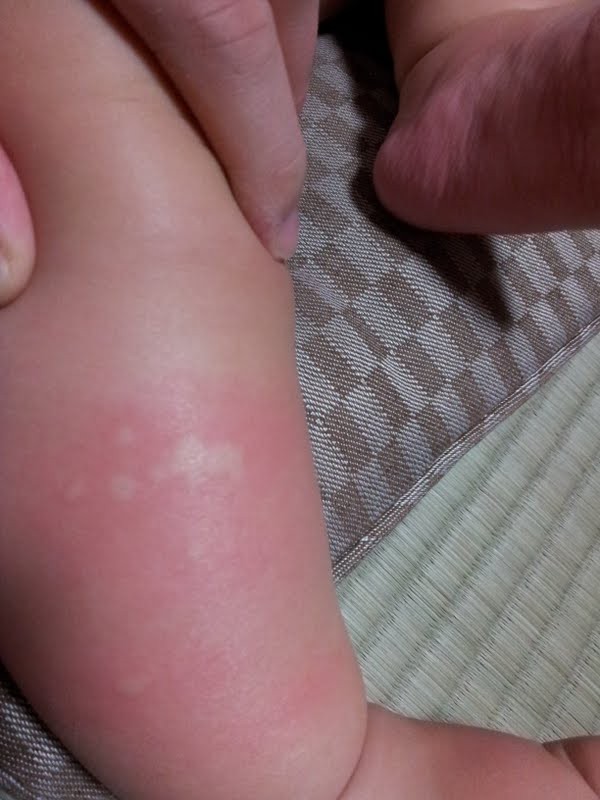 温熱蕁麻疹 Shigemamaのブログ