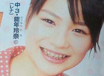 歯列矯正してる女の子 画像集 1 2 歯列矯正 費用 保険