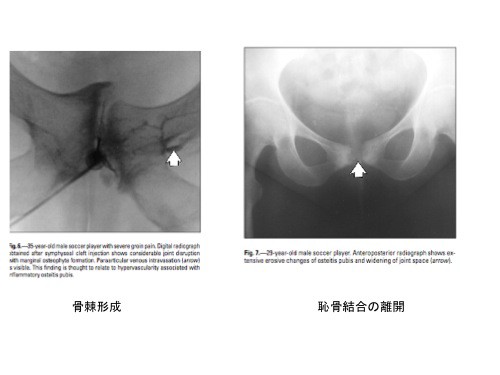 難治性の恥骨結合炎 Athletic Pubalgia に対する ステロイド注入療法の効果 劇的改善が期待 スポーツ整形外科医s Uのブログ Sports Physician S U Blog