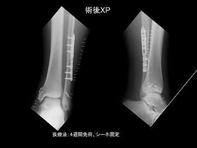 10年最難関手術 ベスト４ ラグビー選手足関節脱臼骨折後のclaw Toe変形を一刀両断 スポーツ整形外科医s Uのブログ Sports Physician S U Blog