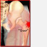 弾発股とは 外側型 Snapping Hip Coxa Saltan スポーツ整形外科医s Uのブログ Sports Physician S U Blog