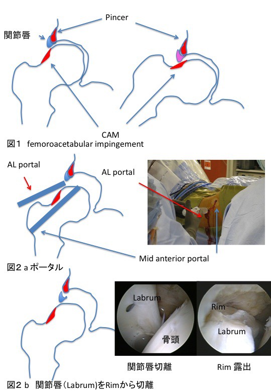 股関節唇損傷の原因は大腿骨寛骨臼インピンジメント Femoroacetabular Impingement が一番多い スポーツ整形外科医s Uのブログ Sports Physician S U Blog