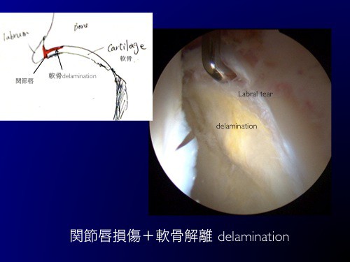 股関節唇損傷に合併する軟骨の剥離 Cartilage Delamination を 鏡視下に 修復する スポーツ整形外科医s Uのブログ Sports Physician S U Blog