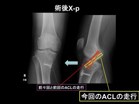 前十字靭帯再建術後に再断裂 再再建術 Acl Revision の極意 Modified Rectangular Btb Revisionでも神の手で作ったナチュラルaclに近づく工夫 スポーツ整形外科医s Uのブログ Sports Physician S U Blog