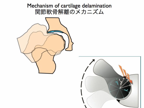 股関節内の寛骨臼側の関節軟骨解離のmr検査の読影 Delaminationの通称 スポーツ整形外科医s Uのブログ Sports Physician S U Blog