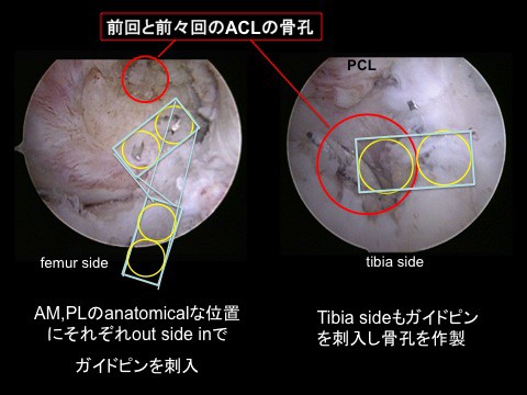 前十字靭帯再建術後に再断裂 再再建術 Acl Revision の極意 Modified Rectangular Btb Revisionでも神の手で作ったナチュラルaclに近づく工夫 スポーツ整形外科医s Uのブログ Sports Physician S U Blog