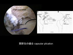 大腿骨頚部骨折後に続く股関節痛の原因 股関節インピンジメント