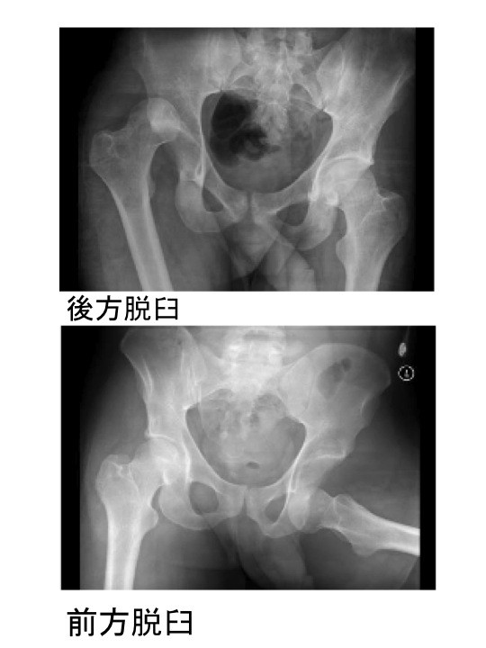 外傷性股関節脱臼の診断 合併症 スポーツ復帰へのマネージメント Vol 1 スポーツ整形外科医s Uのブログ Sports Physician S U Blog