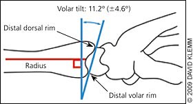 橈骨遠位端骨折保存療法のリハビリ アウトカム 脳卒中にならないためのリハビリテーション
