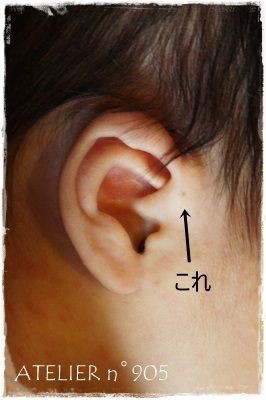 先天性耳瘻孔 Diyで作る こどもと過ごすおうち時間 先天性耳瘻孔 Diyで作る こどもと過ごすおうち時間