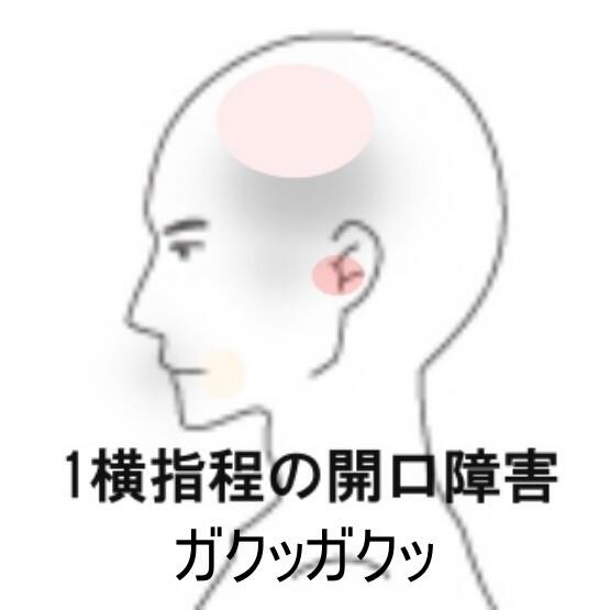 顎関節症 室蘭登別すのさき鍼灸整骨院 症例報告 すのさき鍼灸整骨院 副院長のブログ