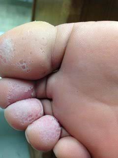 足の裏の皮膚に穴開く奴www 画像あり 流速vip