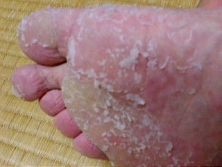 足裏の変貌 ３日目 割れ鍋に綴じ豚